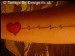 Heart Attack
