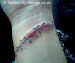 slit wrist stitched up